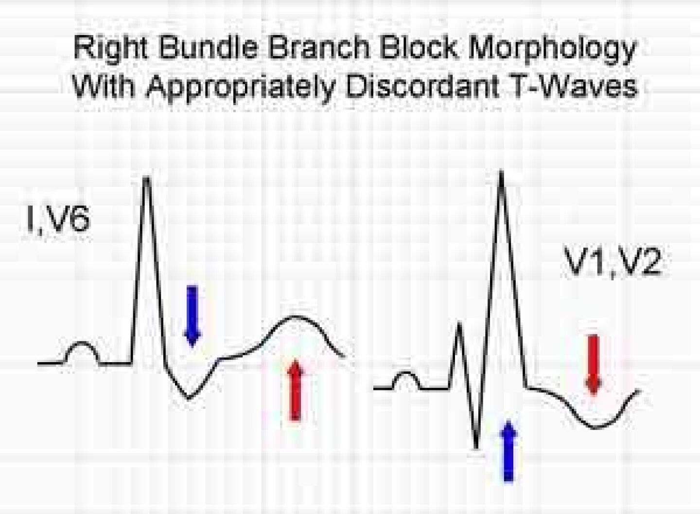 RBBB_morphology-small.jpg