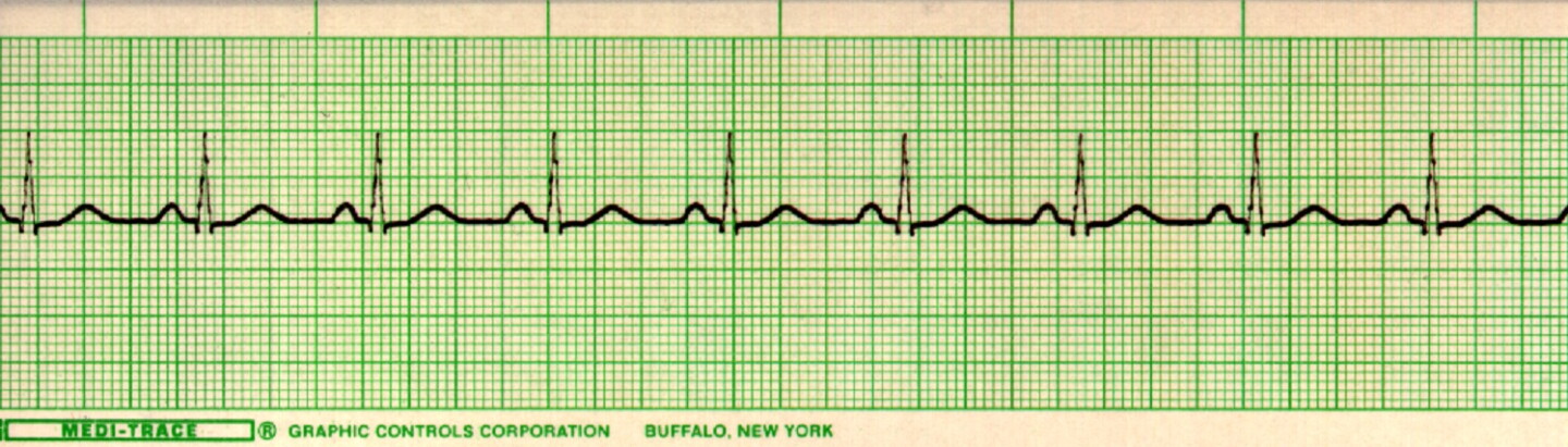 Sinus R1 Become an EKG detective
