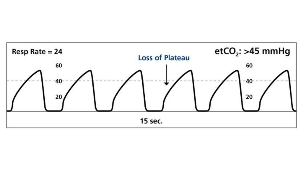 Obstructive Pattern Capnography 5 medical conditions where capnography can affect BLS care