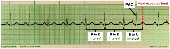 EKG interpretation cheat sheet: Premature atrial contractions