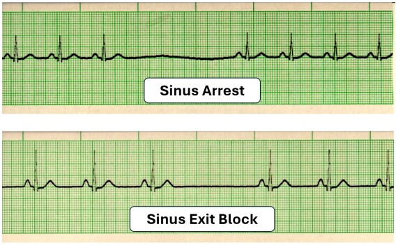 EKG Detective: Sinus arrest vs. sinus exit block