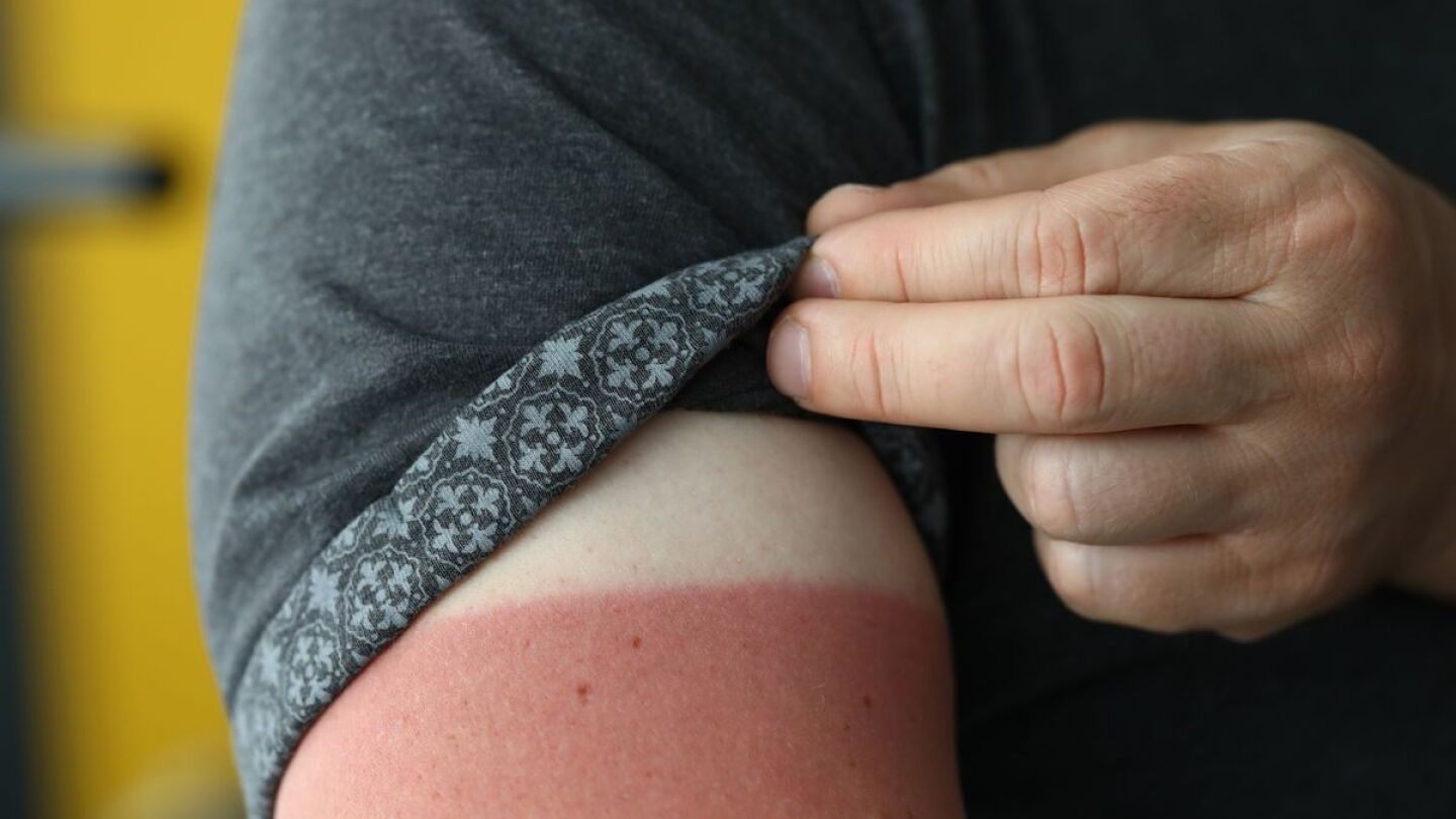 Firefighter Rashes Firefighter skin cancer: How to protect yourself on the job