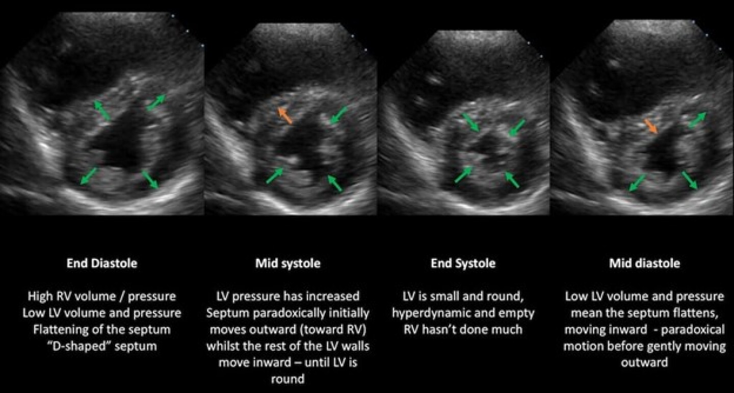 Dsign Rv Failure Identifying right ventricular failure