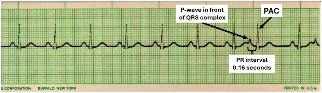 EKG interpretation cheat sheet: Premature atrial contractions