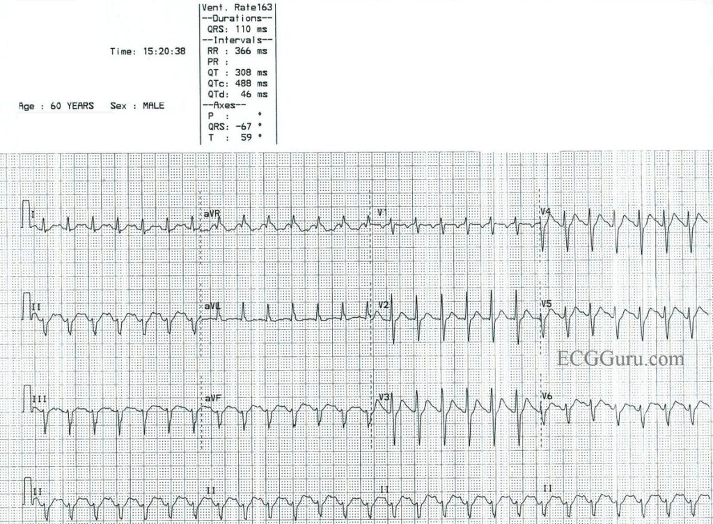 Svt Vs Normal SVT vs sinus tachycardia: SVT ECG strip interpretation