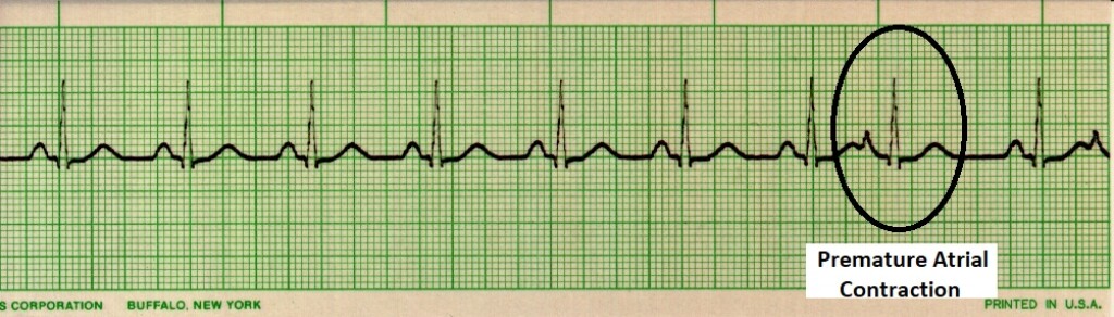 EKG interpretation cheat sheet: Premature atrial contractions