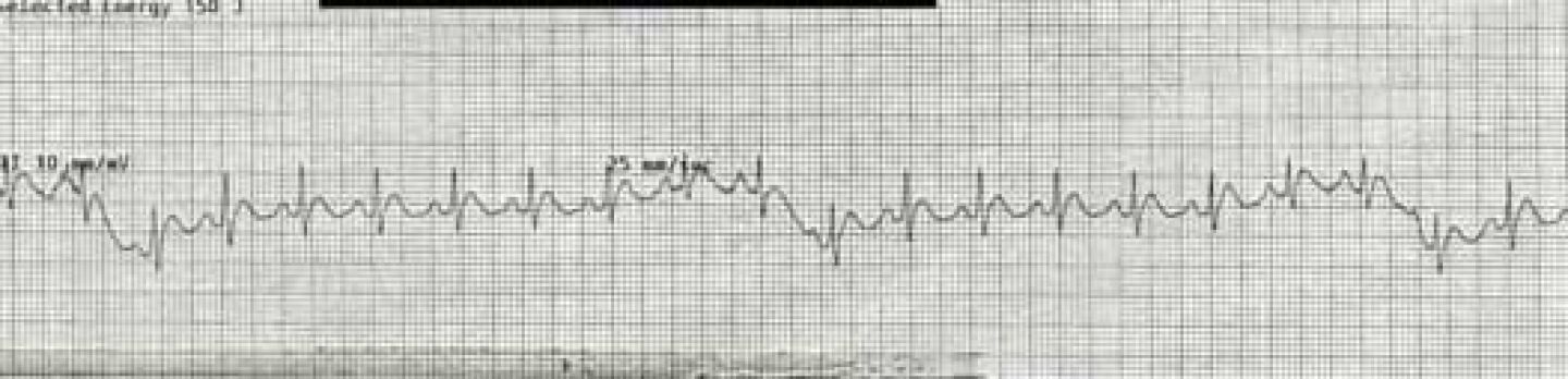 1027-ekg-4-small.jpg