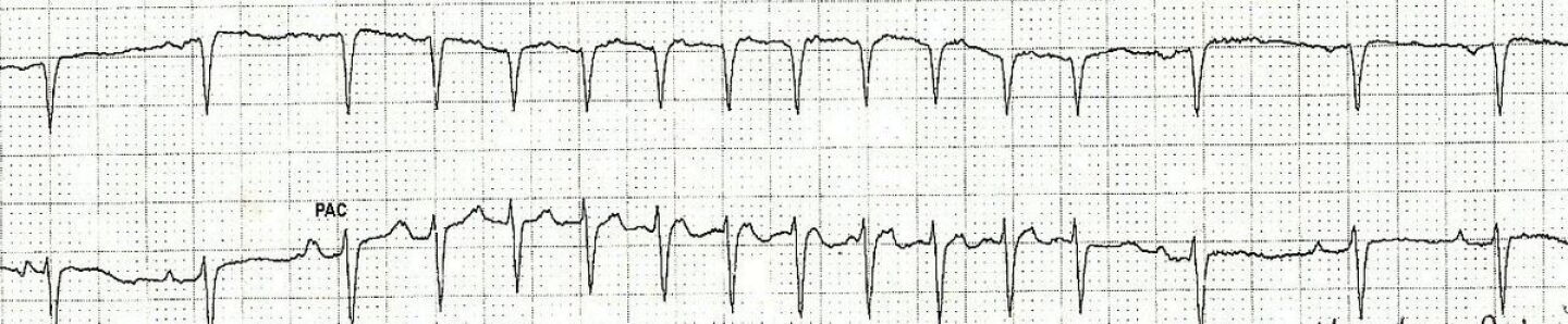 Svt Vs Normal SVT vs sinus tachycardia: SVT ECG strip interpretation