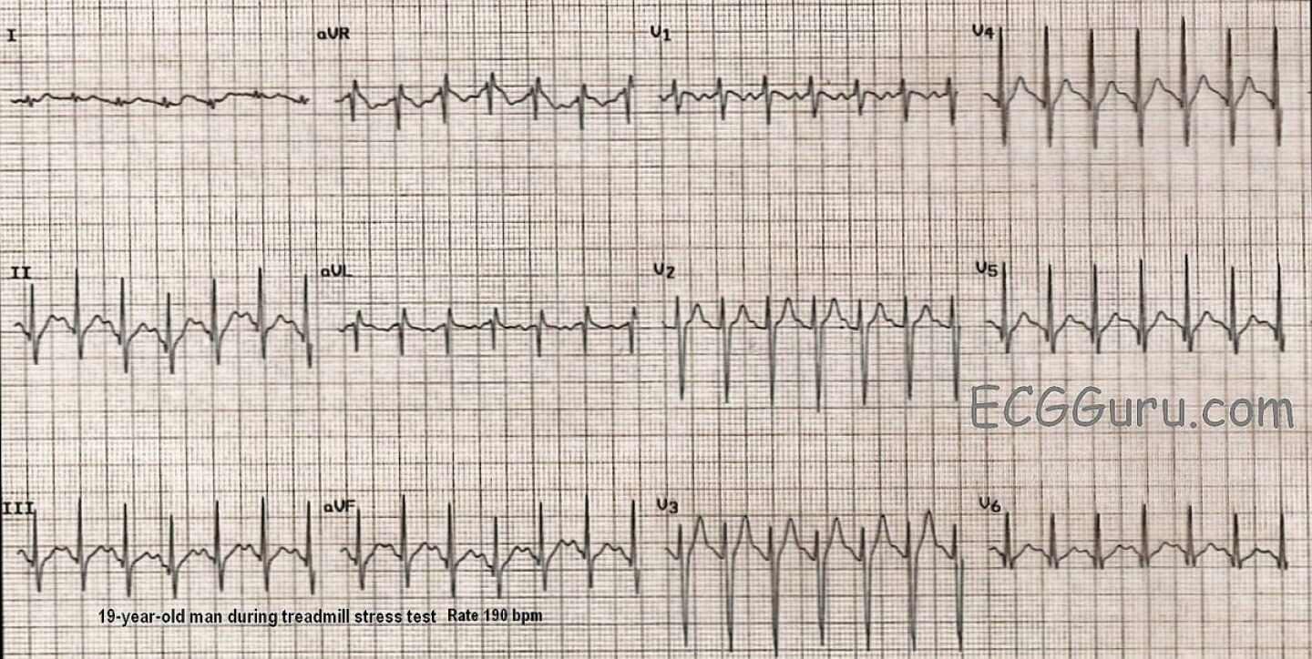 Examples Of Svt Supraventricular Tachycardia Vs Sinus Tachycardia