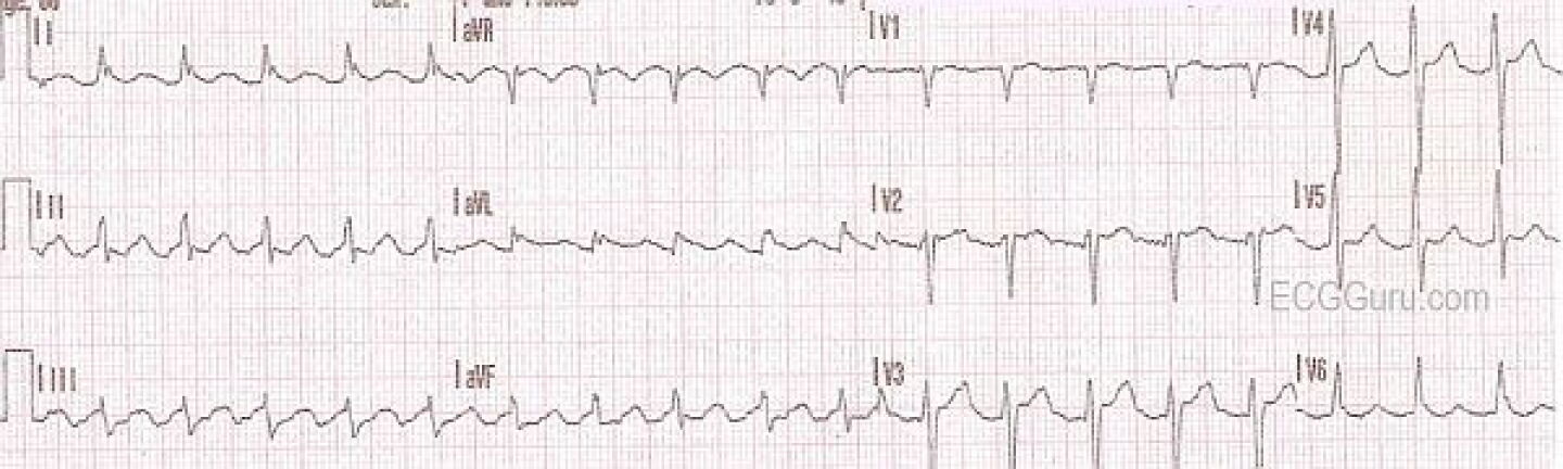 Aflutter Conduction Patterns How to identify atrial flutter with 2:1 conduction on ECG: 10 expert tips