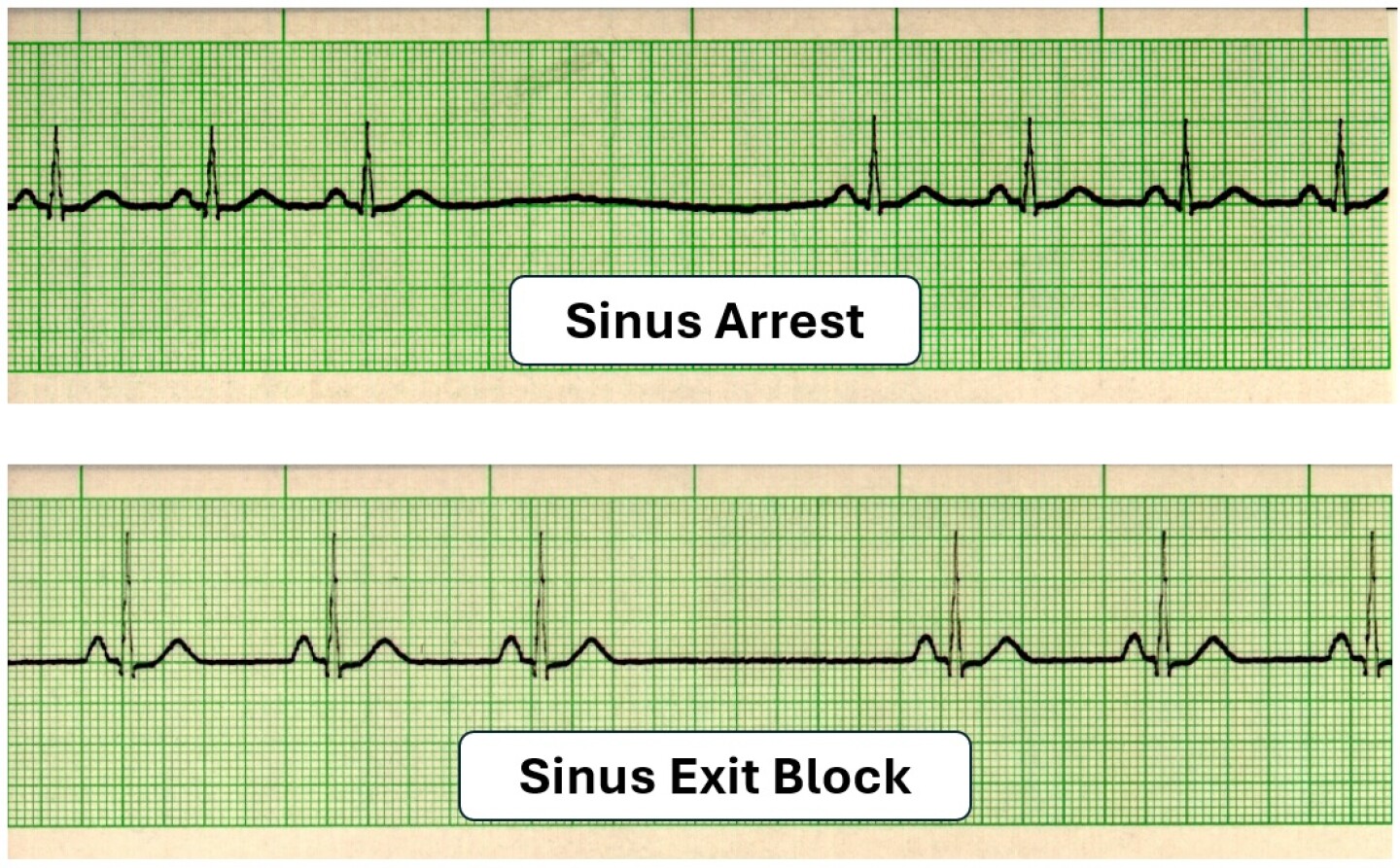 EKG Detective Sinus arrest vs. sinus exit block