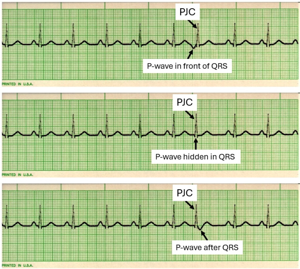 Septal R Wave EKG interpretation: Recognizing premature junctional contractions