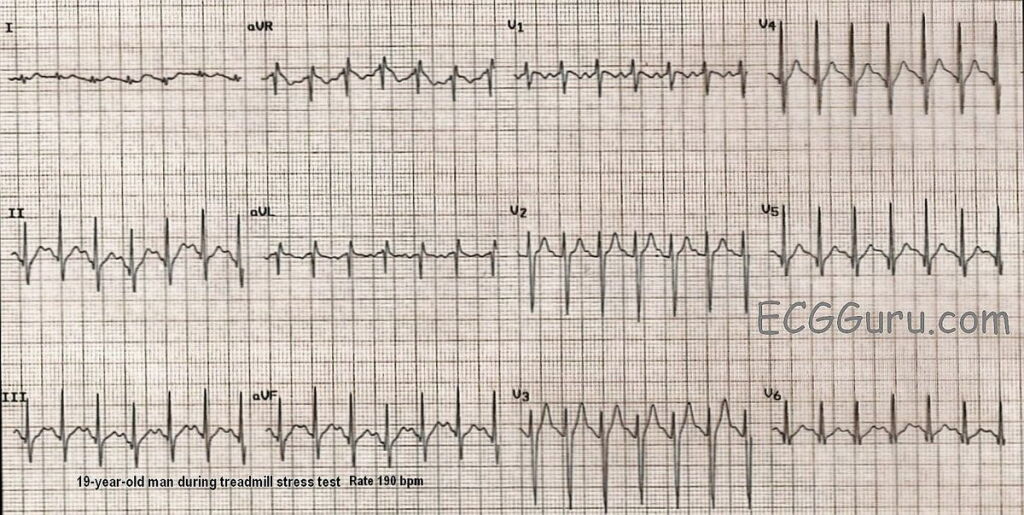 Svt Vs Normal SVT vs sinus tachycardia: SVT ECG strip interpretation