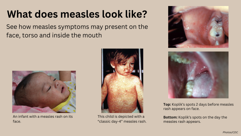 EMS guide to measles: Symptoms, transmission and response protocols