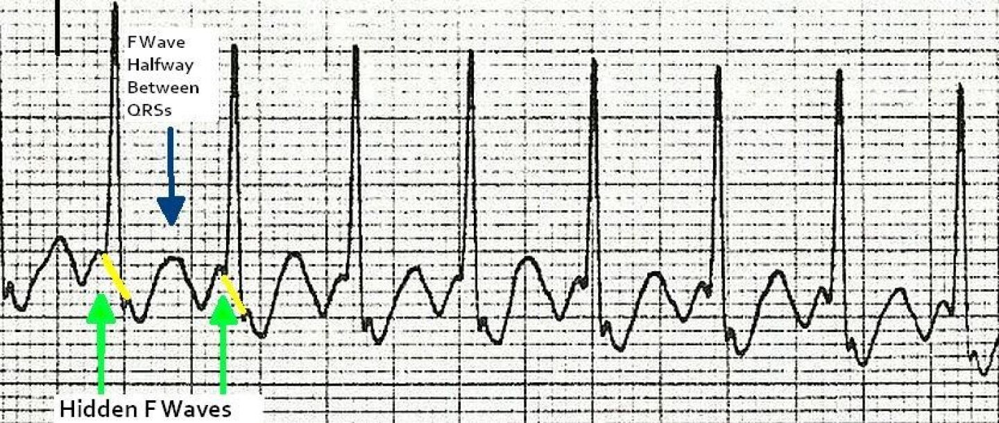 Aflutter Conduction System How to identify atrial flutter with 2:1 conduction on ECG: 10 expert tips