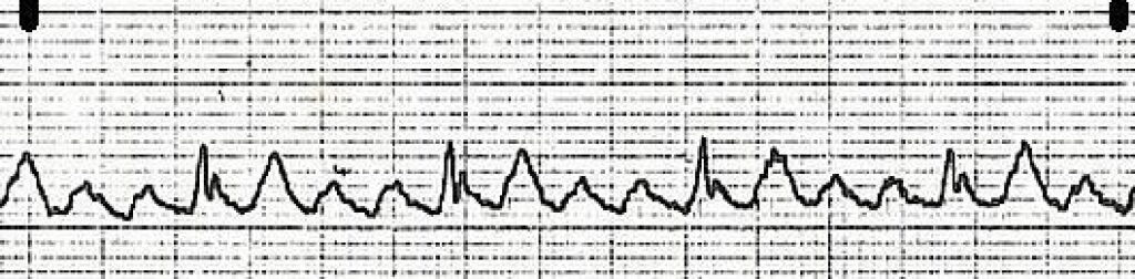Aflutter Conduction Patterns How to identify atrial flutter with 2:1 conduction on ECG: 10 expert tips