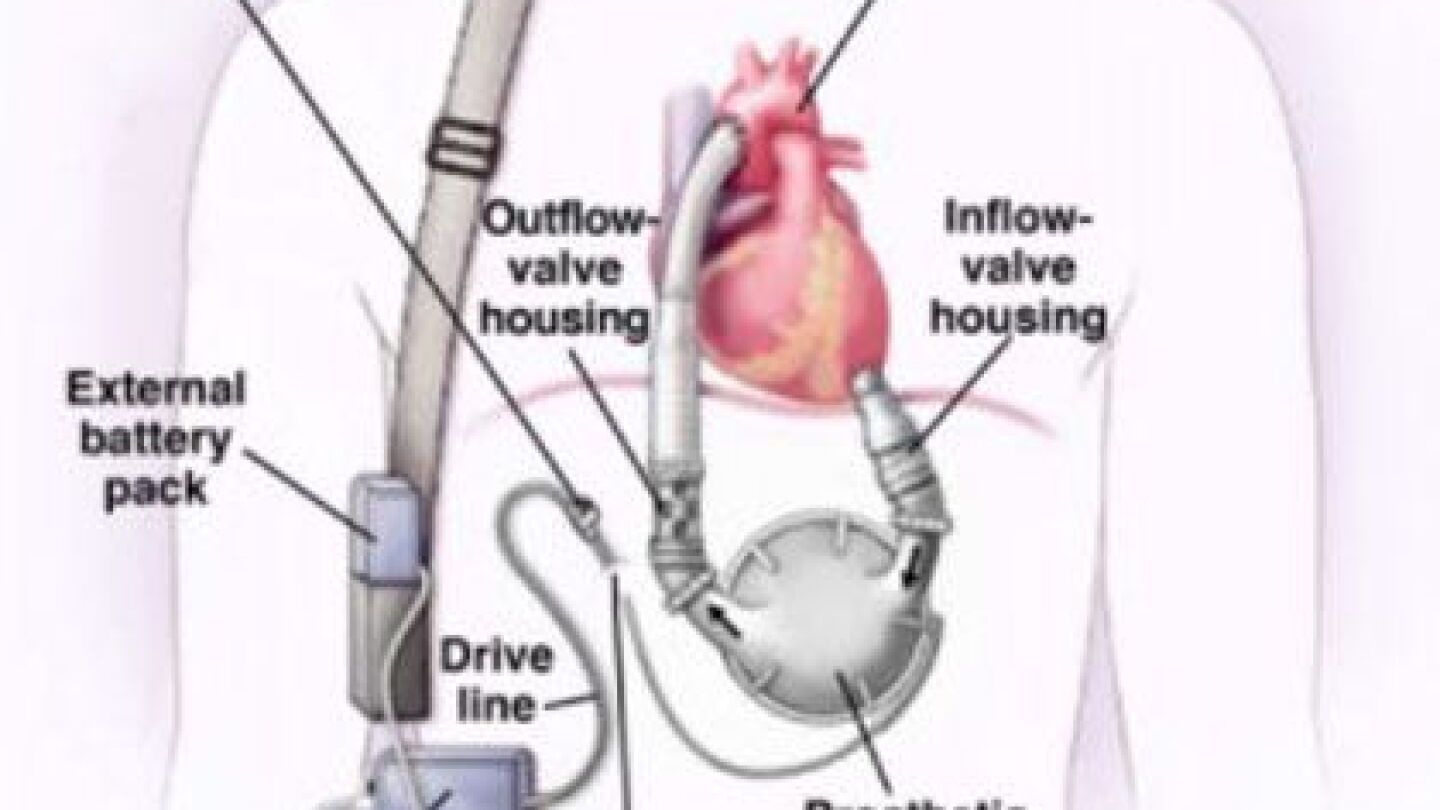 Lvad Map Lvad