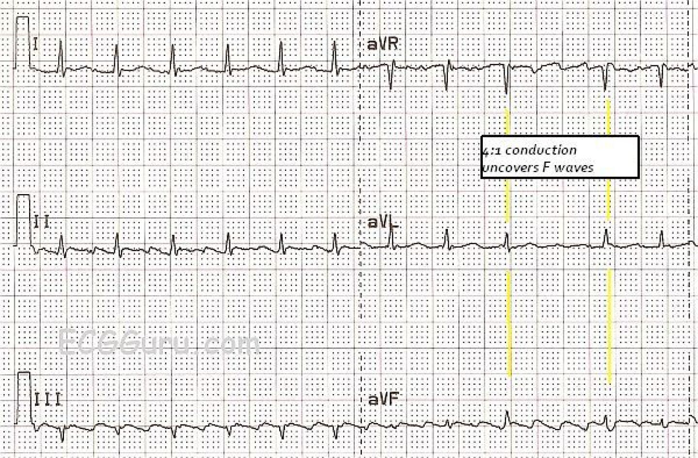 Aflutter Conduction System How to identify atrial flutter with 2:1 conduction on ECG: 10 expert tips