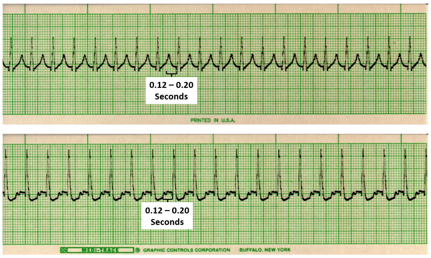 EKG Detective: Atrial tachycardia