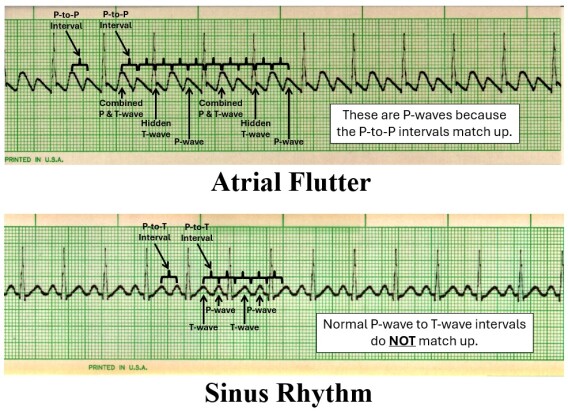EKG Detective: Atrial flutter