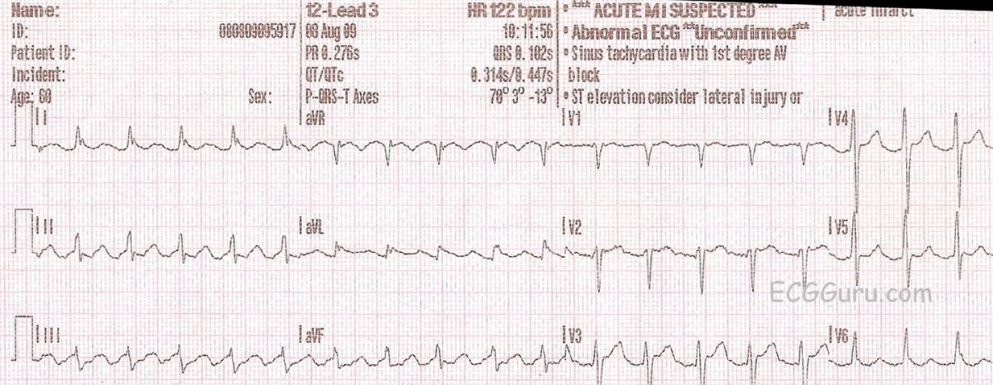 Algorithm For Atrial Flutter How to identify atrial flutter with 2:1 conduction on ECG: 10 expert tips