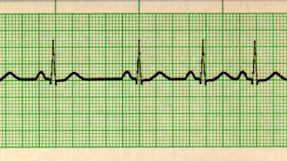Abnormal Sinus Rythm EKG Detective: Sinus arrhythmia