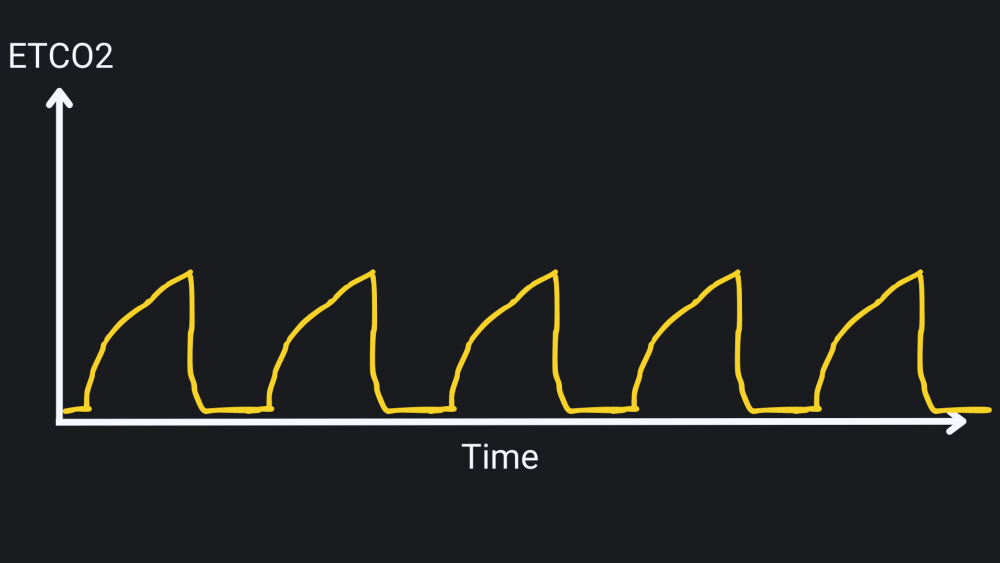 Obstructive Pattern Capnography Capnography and respiratory arrest: A guide for paramedics, EMTs