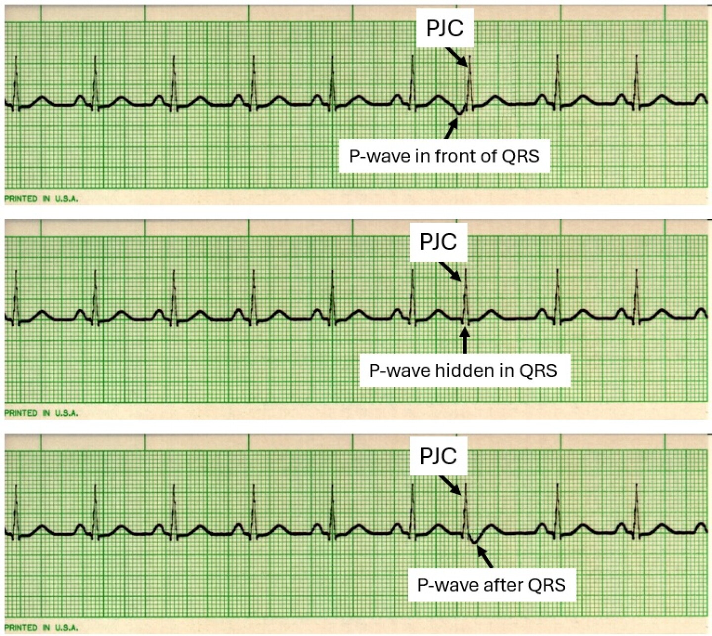 Ecg Wave Example EKG interpretation: Recognizing premature junctional contractions