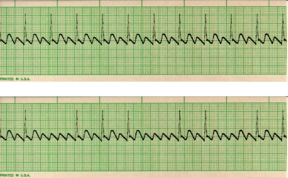 Examples Of Aflutter EKG Detective: Atrial flutter