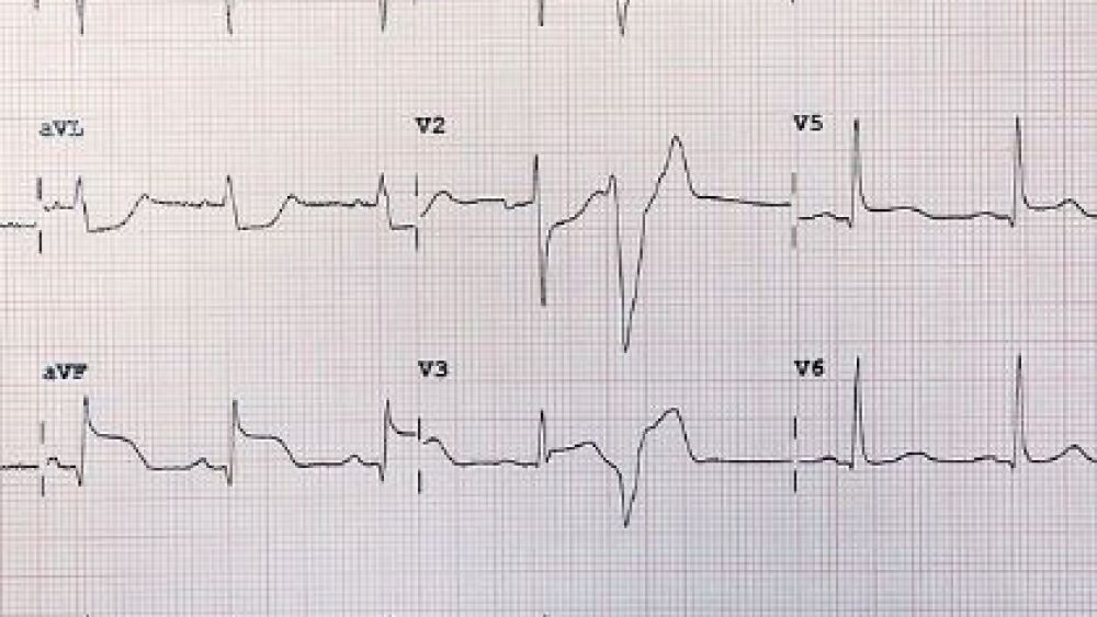 ST_Segment_Elevation_Myocardial_Infarction_Unlabeled.jpg