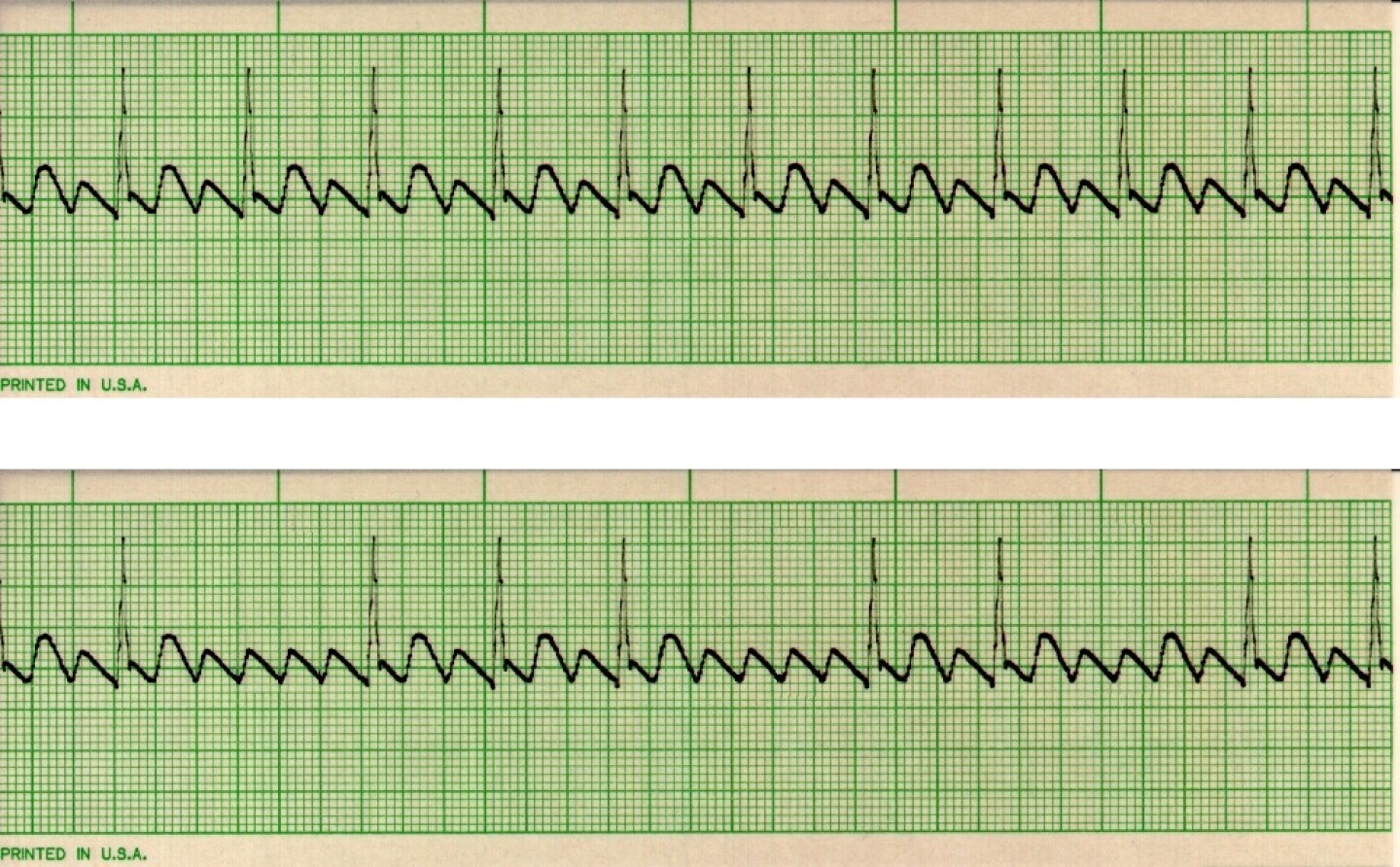 Flutter-Figure 2 - Example of Atrial Flutters.jpg