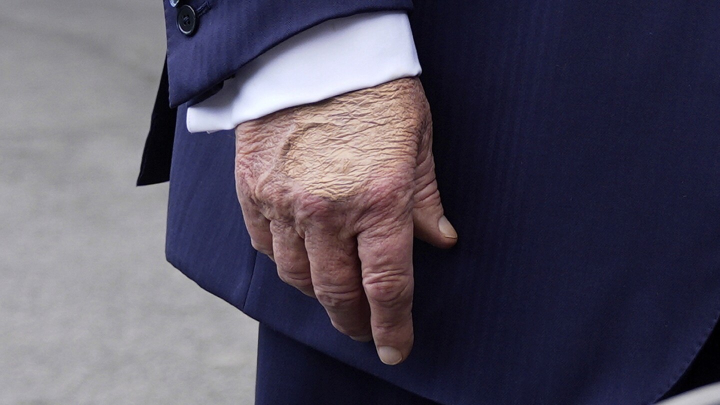 Trump diagnosed with chronic venous insufficiency after medical exam