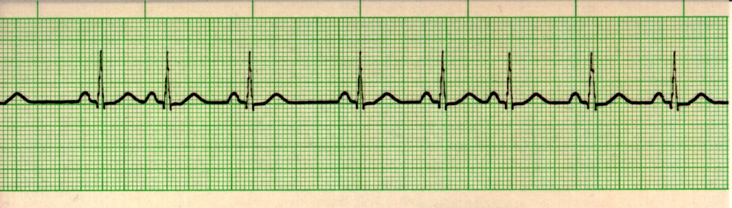 Abnormal Sinus Rythm EKG Detective: Sinus arrhythmia