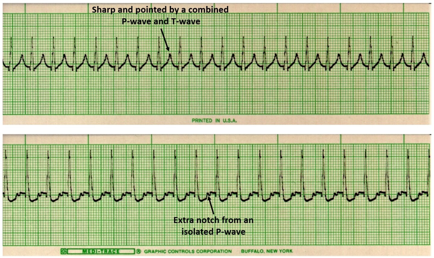 Figure 5 - Examples of Combined P & T Waves.jpg