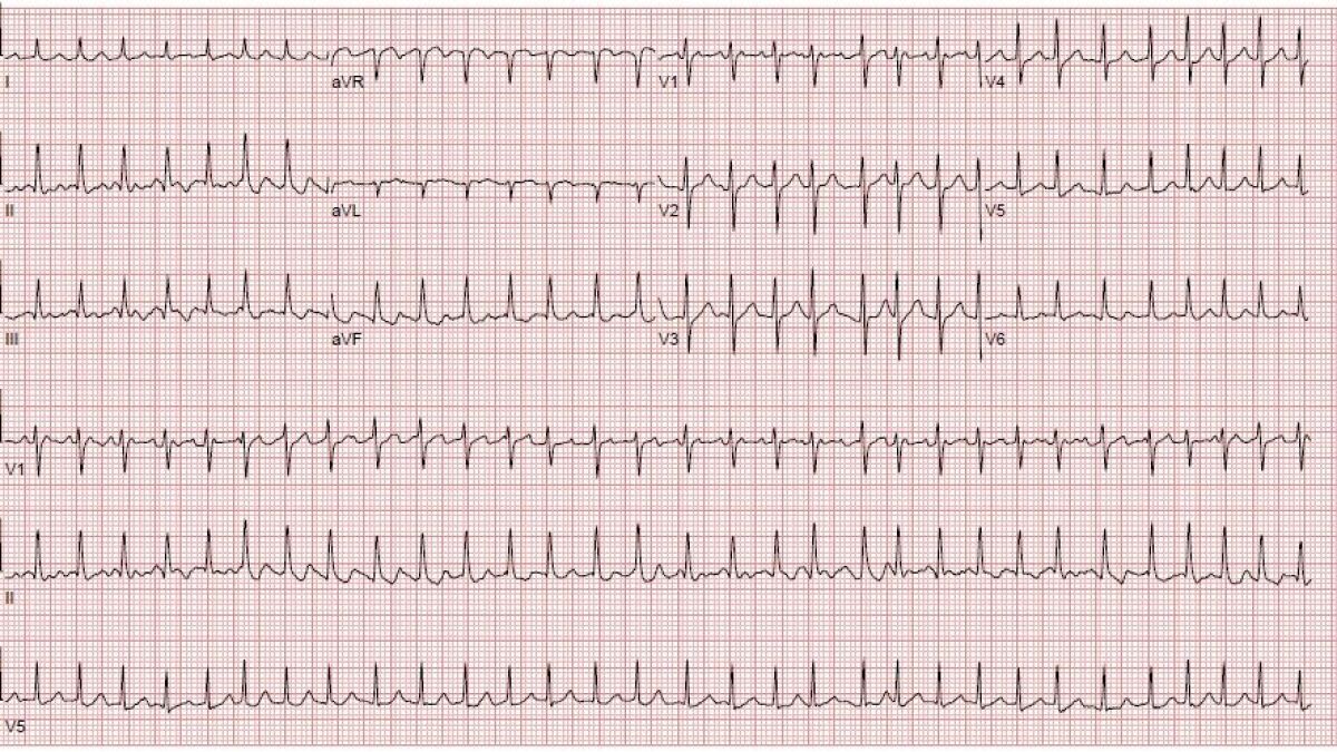 A-fib RVR vs 2:1 AFL vs PSVT 심방세동과 심방조동 그리고 발작성 상심실성 빈맥의 구분 : 네이버 블로그