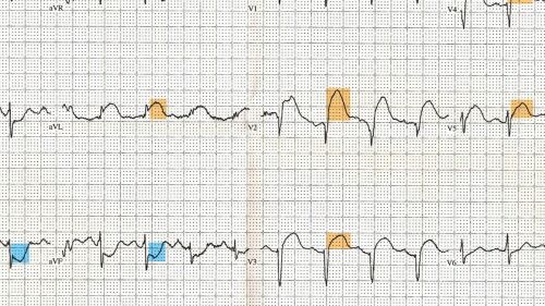 12_Lead_EKG_ST_Elevation_tracing_color_coded.jpg