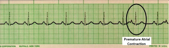 EKG interpretation cheat sheet: Premature atrial contractions