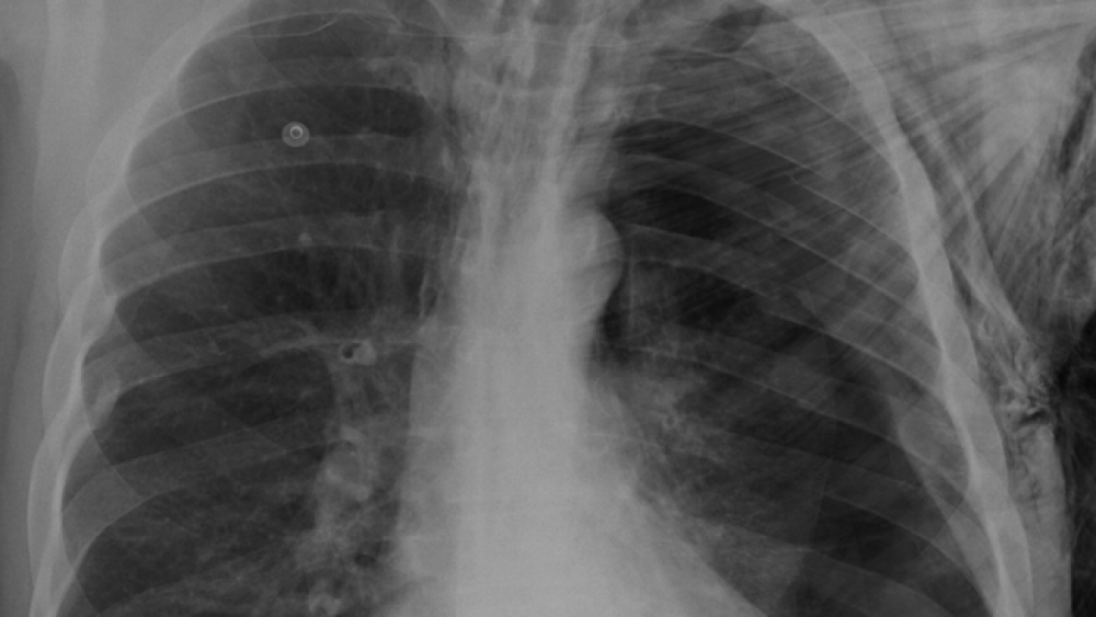 Tension pneumothorax: Capnography and ultrasound tips Tension pneumothorax: Capnography and ultrasound tips